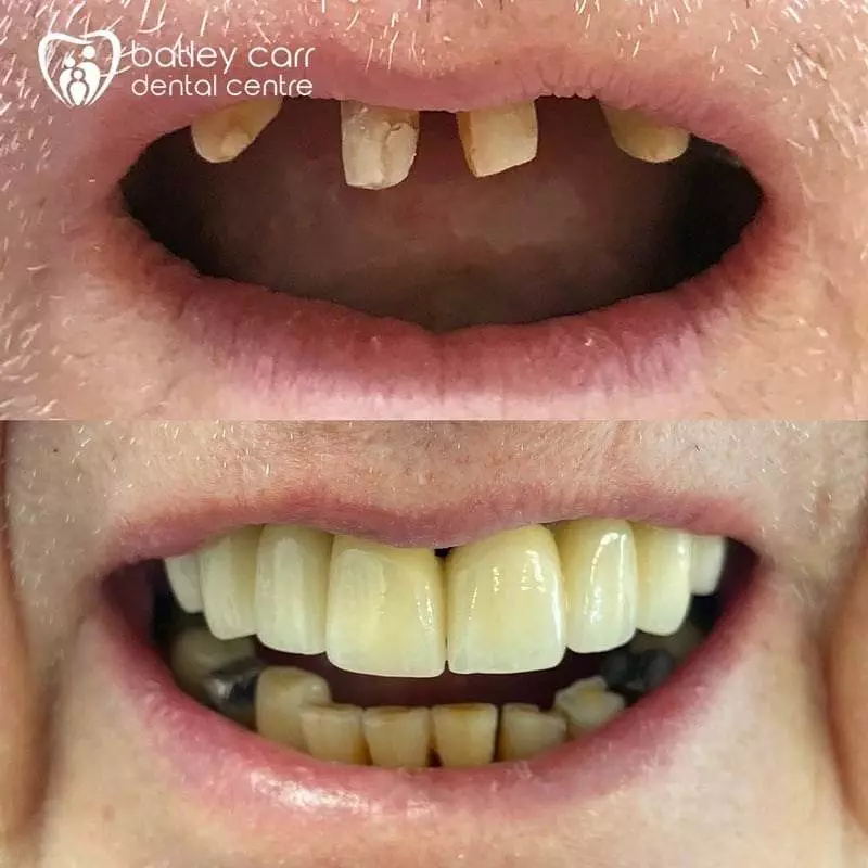 13.Full-mouth-reconstruction-where-patient-had-lost-a-bridge.-New-bridge-was-made-and-a-denture-constricted-Aesthetics-and-function-restored-p-800 (1) 20 13.Full mouth reconstruction where patient had lost a bridge. New bridge was made and a denture constricted Aesthetics and function restored p 800 1