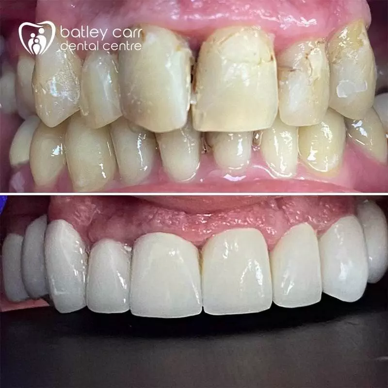 15.Full mouth rehabilitation using upper fixed ceramics. p 800