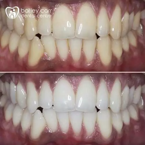 16.teeth whitening p 500
