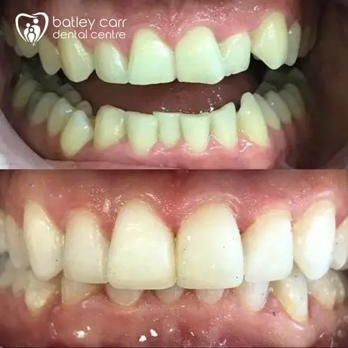 17.Invisalign-whitening-and-edge-bonding-p-500 (1) 22 17.Invisalign whitening and edge bonding p 500 1