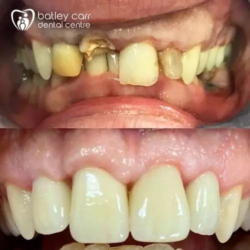5-Smile-makeover-Re-root-canal-treatments-posts-gum-lift-emax-crowns-p-500 (1) 21 5 Smile makeover Re root canal treatments posts gum lift emax crowns p 500 1